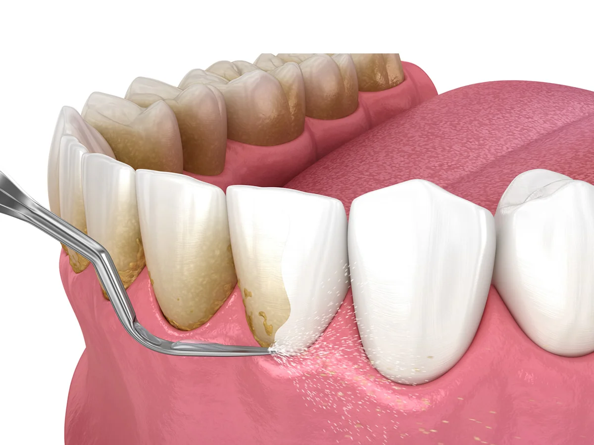 Dentista realizando raspagem de tártaro em paciente para manter a saúde bucal.