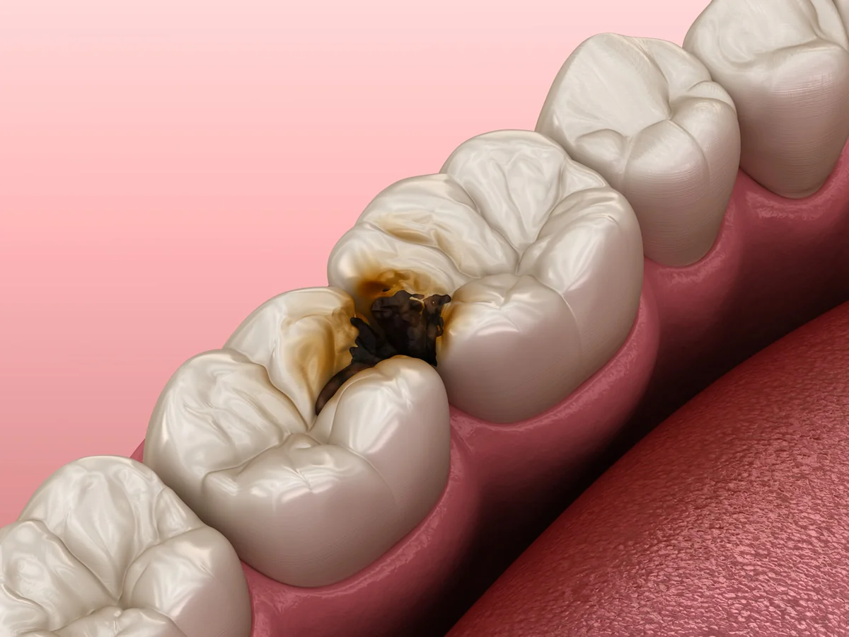 Removendo cárie de um dente durante o tratamento odontológico.